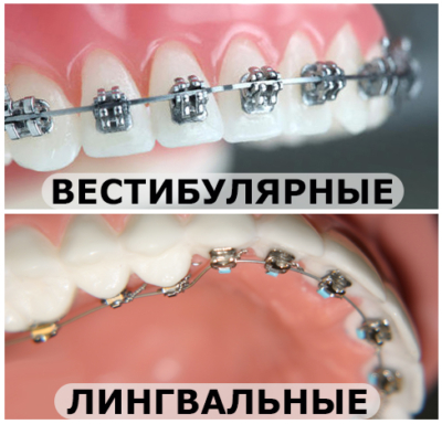 Зачем ставят брекеты на зубы взрослым и детям? Как ухаживают и снимают?