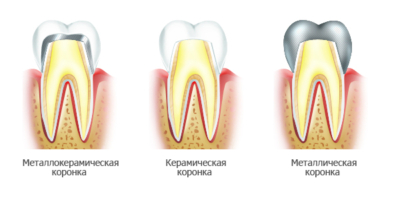 Как спасти жевательные зубы? Какие коронки лучше: керамические или циркониевые?